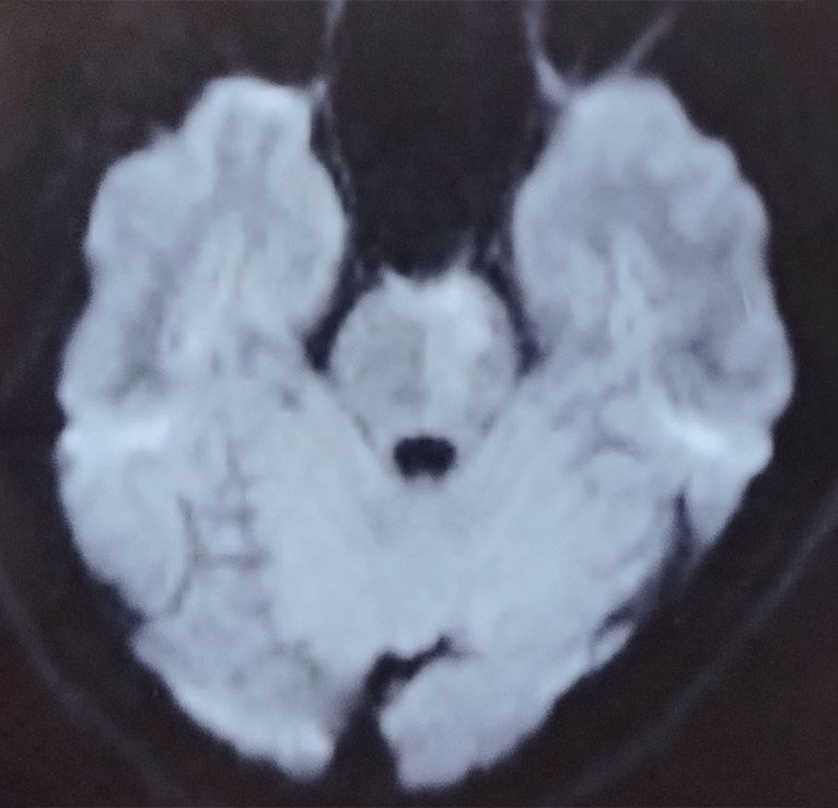 MRI-Brain